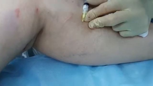 Склеротерапия в операционной
