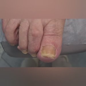 Обработка ногтей с грибковой инфекцией в центре подологии СТОПАМЕР