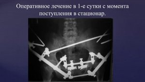 7. Новое поколение аппаратов внешней фиксации - лечение нестабильных повреждений таза