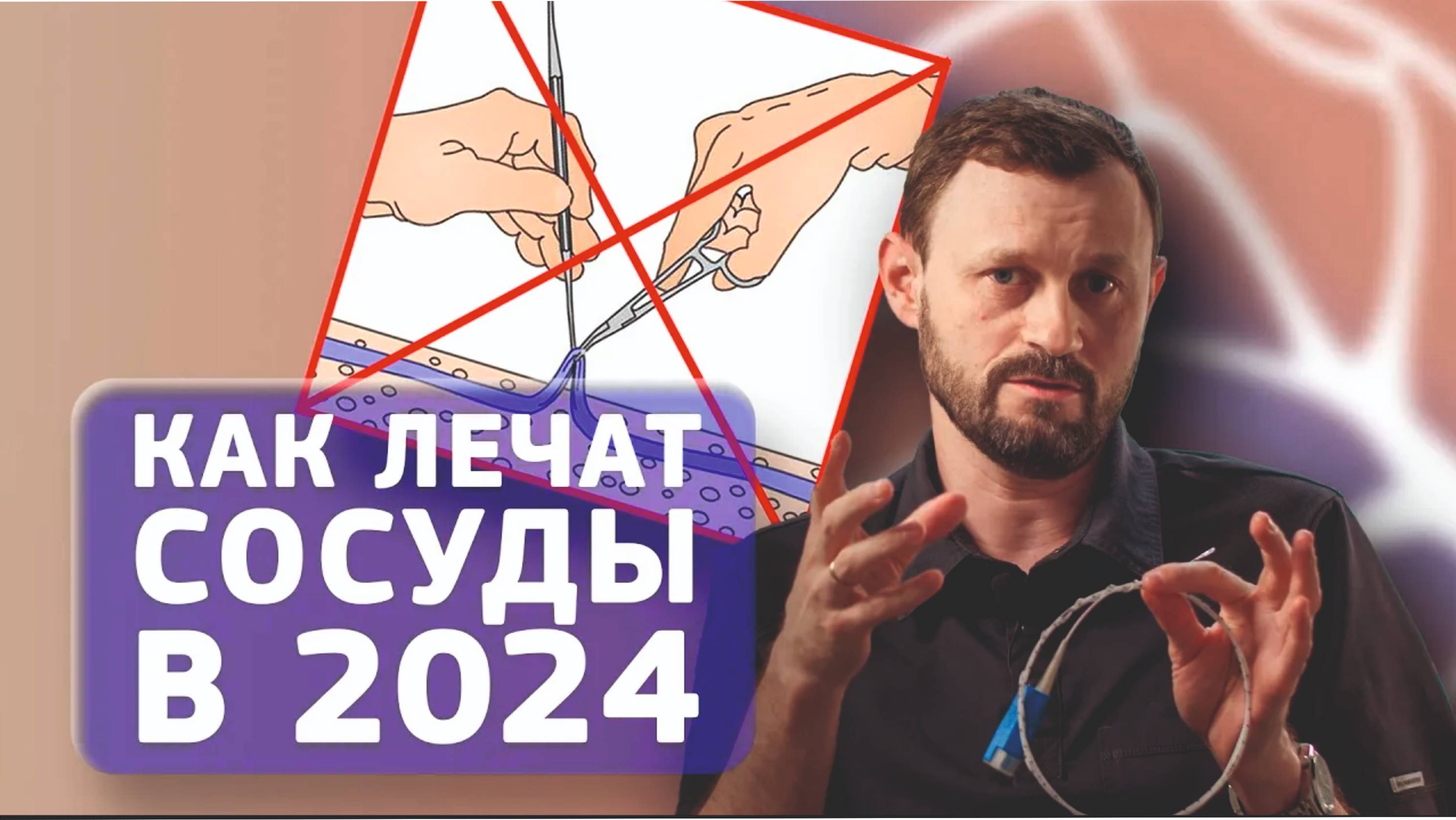 ЛАЗЕРНАЯ АБЛЯЦИЯ - современный способ борьбы с варикозной болезнью | Кирилл Самохин
