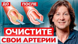 ПЕРВЫЕ симптомы атеросклероза! Как БЫСТРО избавиться от холестериновых бляшек?