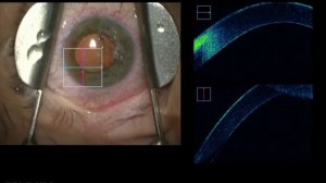 OACS - OCT Assisted Corneal Surgery -  Removal of Salzmann's Nodule with Zeiss Callisto Lumera