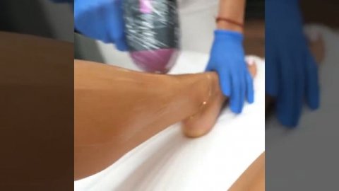 Лазерная эпиляция