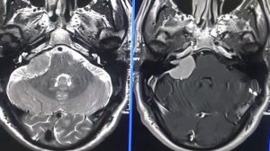 INTERNAL ACOUSTIC CANAL TUMOR _ BRAIN MRI WITH INJECTION #MRI #siemems #Aera #radiology