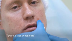 Контурная пластика full face у мужчин