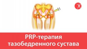 PRP-терапия тазобедренного сустава