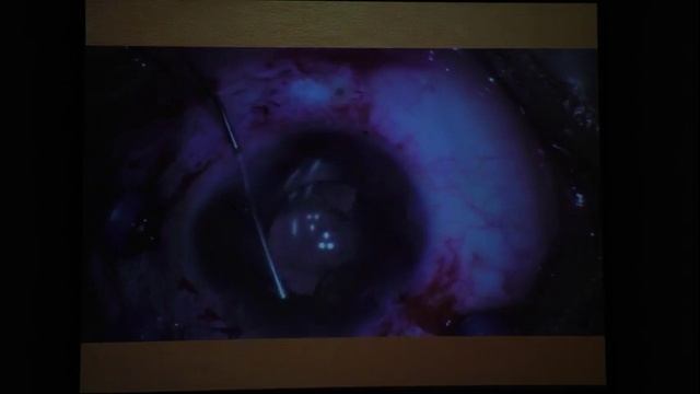 Применение тяжелого силиконового масла Densiron68 в педиатрической практике. Махмутов В.Ю. смотреть онлайн