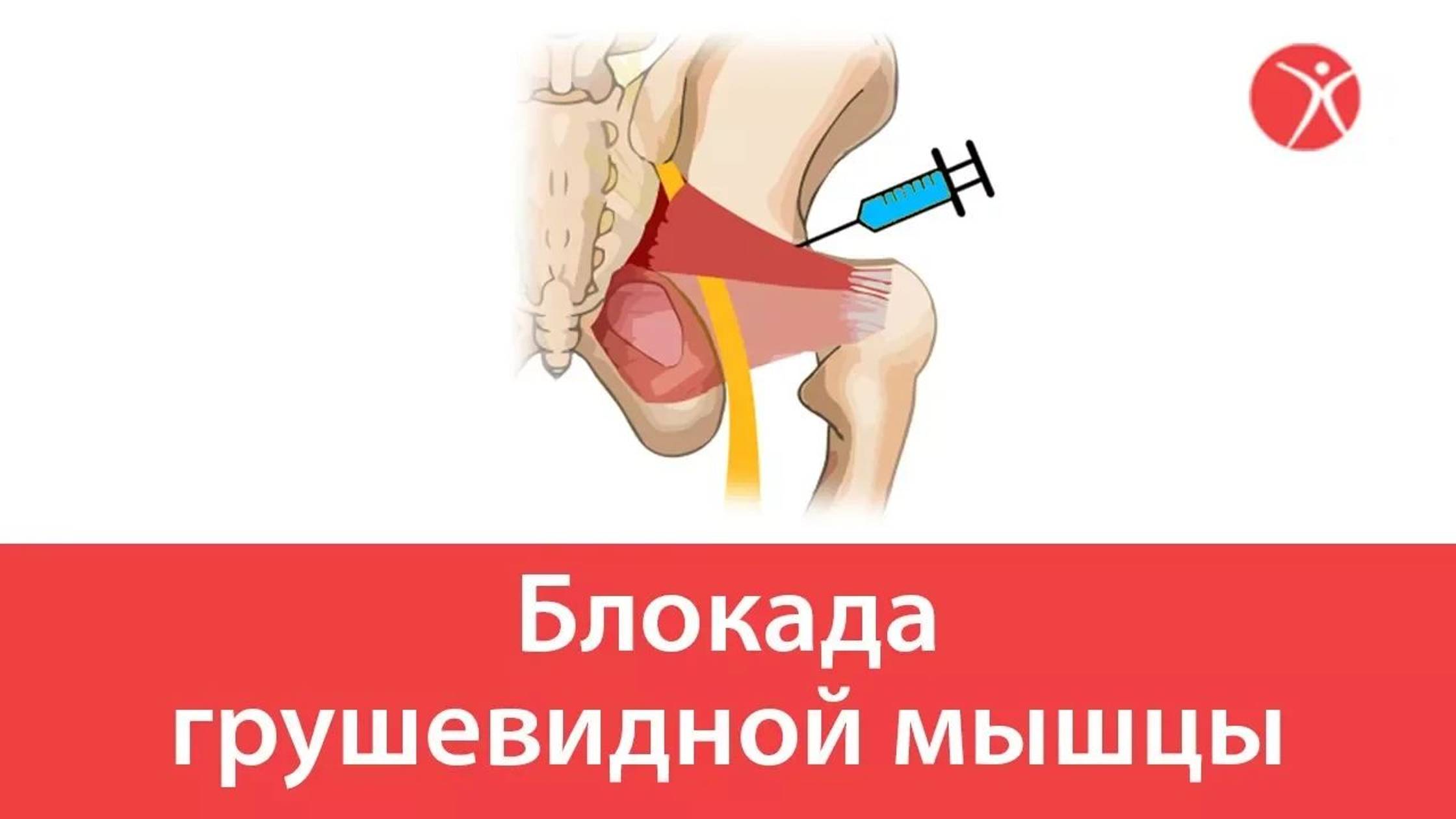 Блокада грушевидной мышцы в клинике Стопартроз