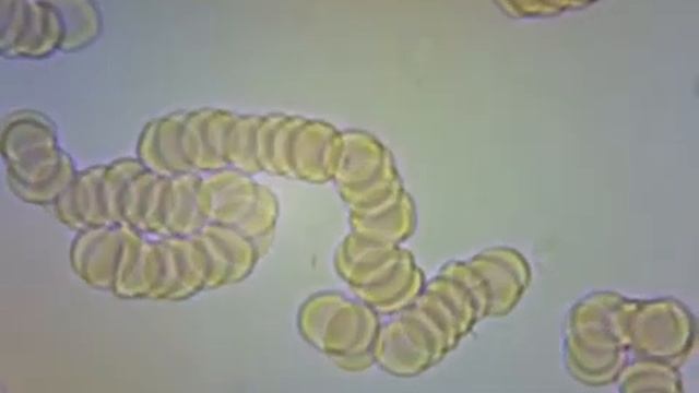 Кровь на темнопольном микроскопе Ребёнок 4 года смотреть онлайн