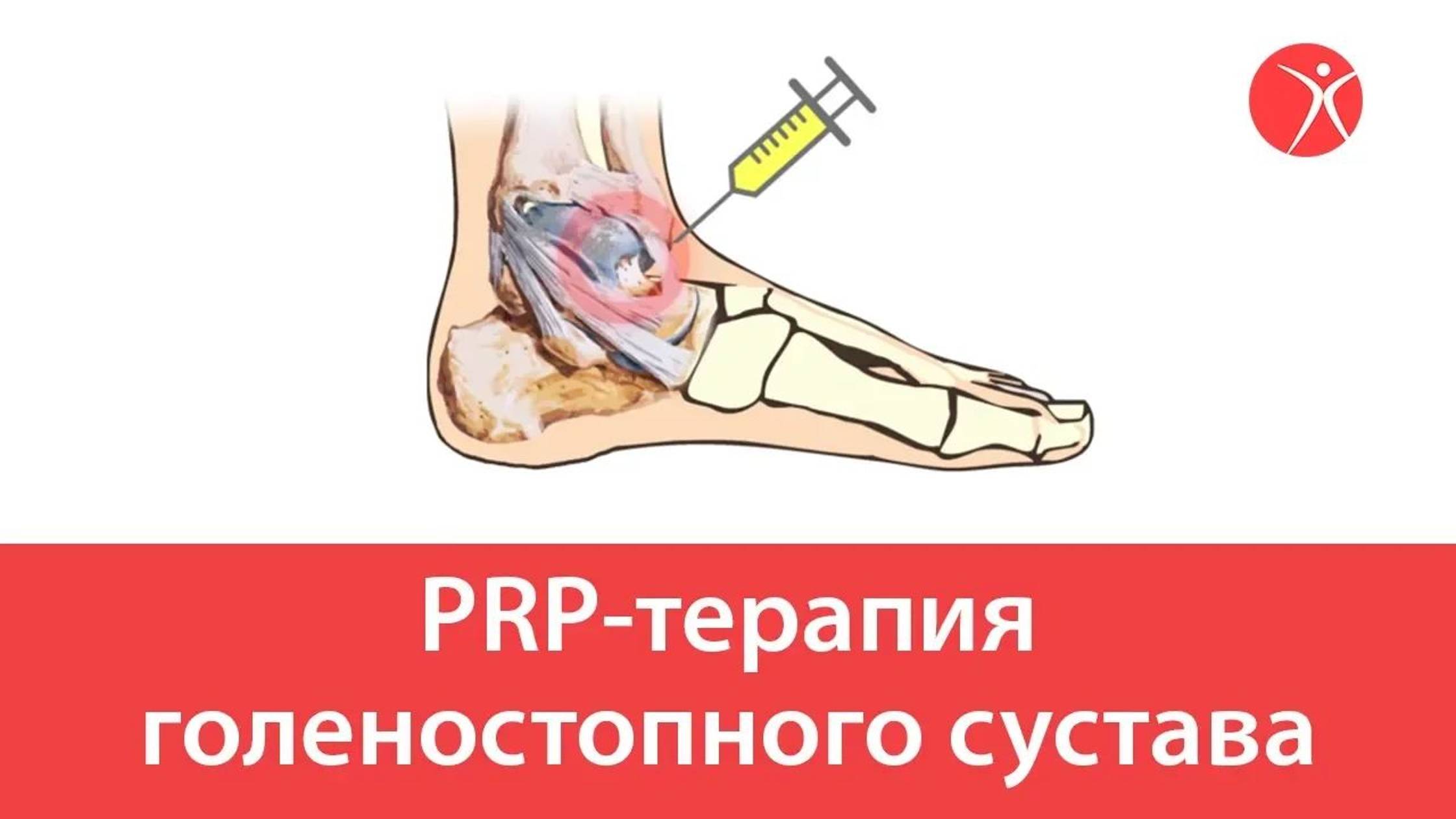 PRP-терапия голеностопного сустава