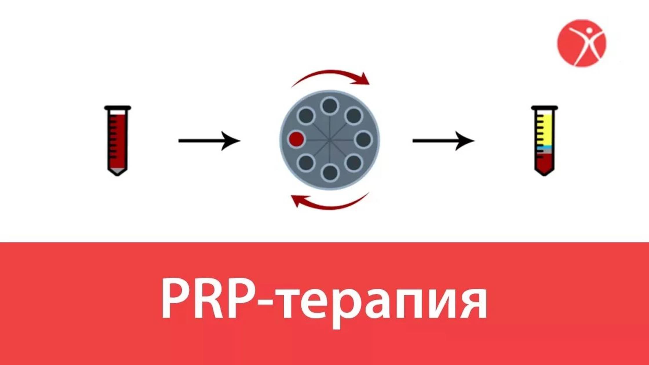 PRP-терапия в клинике Стопартроз