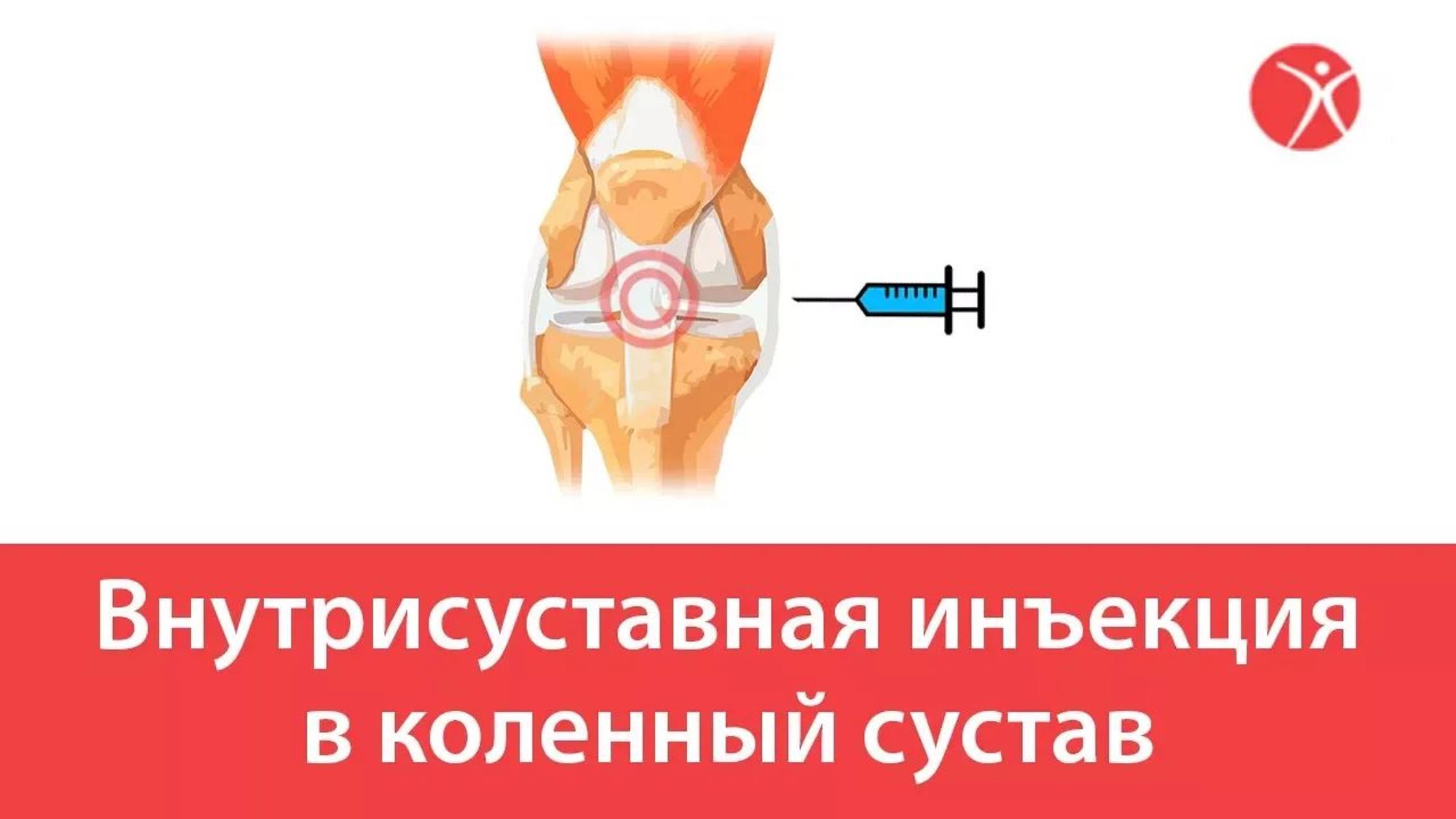 Внутрисуставная инъекция в коленный сустав в клинике Стопартроз