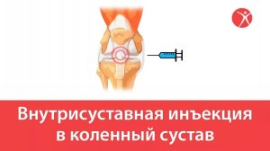 Внутрисуставная инъекция в коленный сустав в клинике Стопартроз