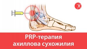 PRP-терапия ахиллова сухожилия