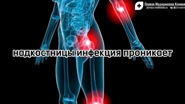 Гематогенный остеомиелит: инфекционный процесс, острая форма заболевания и терапия