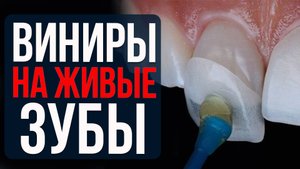 Почему Виниры ставят на Живые Зубы?