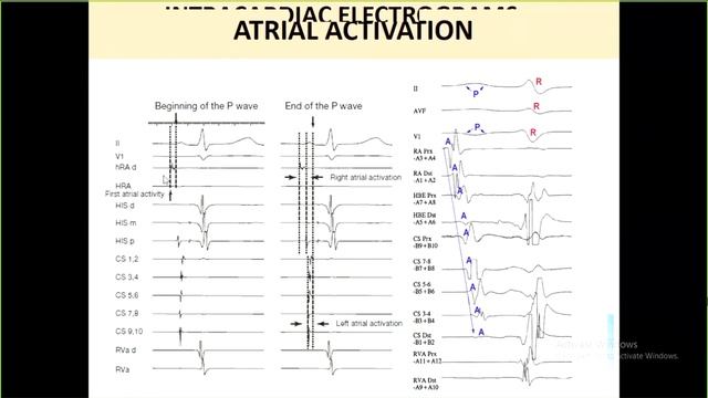 ECG vs Intracardiac Electrogram - Dr Arun Gopi смотреть онлайн
