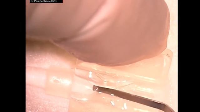 ФАКО с имплантацией ИОЛ Optovet AnIOL 40D-5510 / PHACO with implantation IOL Optovet AnIOL 40D-5510 смотреть онлайн