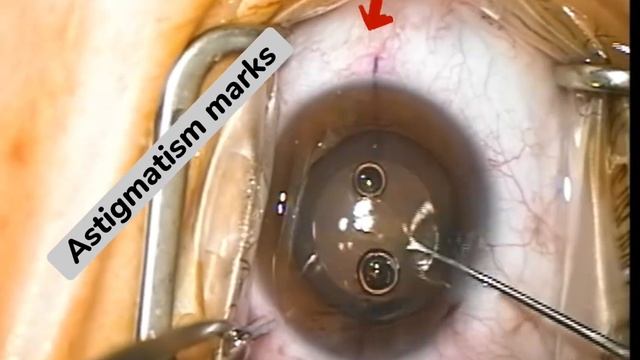 Toric ICL surgery 🤓 смотреть онлайн