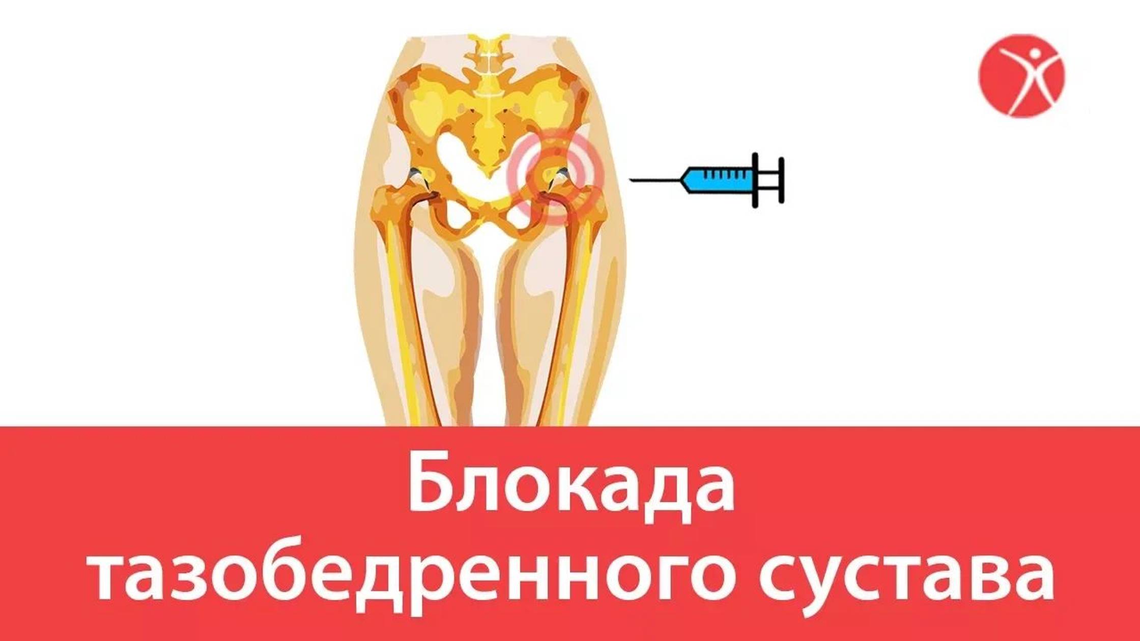 Блокада тазобедренного сустава в клинике Стопартроз