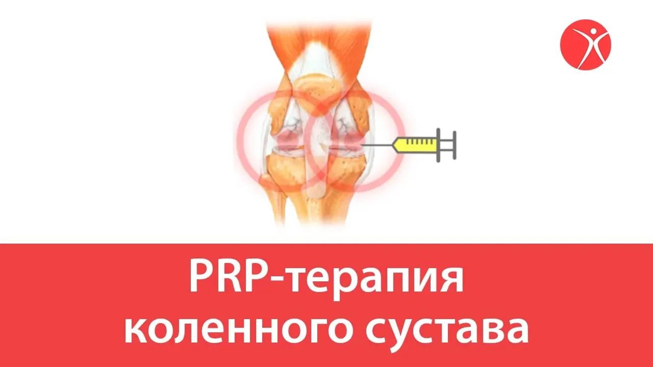 PRP-терапия коленного сустава