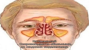 Симптомы и причины хронического гайморита