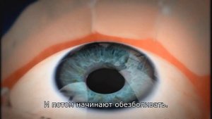 Операция на глаза LASIK | Отзыв пациента