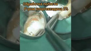 Лечение зуба 46. Несостоявшаяся эндодонти