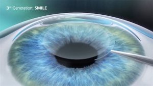 ПОПУЛЯРНО о "Лазерная коррекция зрения Смайл SMILE"