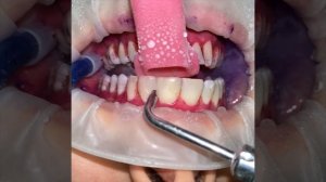 Чистка зубов под микроскопом.