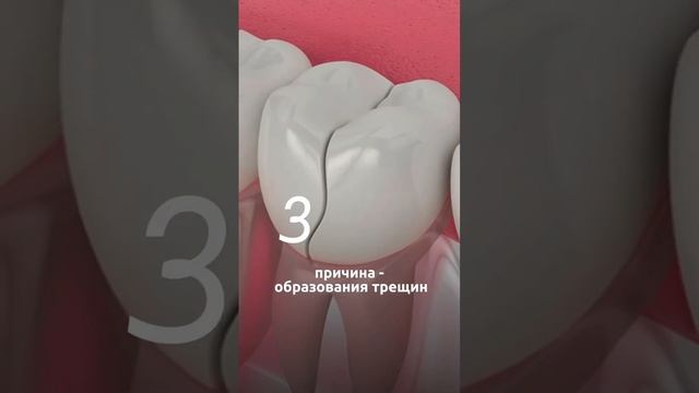 Трещина на зубах - откуда?! #colibridental #colibridentalclinic #лечениезубов #кариес #эндодонтия