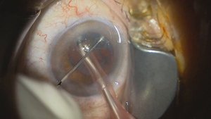 06 phaco 20230201 164132 clareon alcon