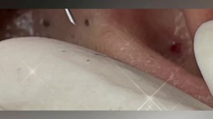 Blackhead popping satisfying| Blackhead removal asmr