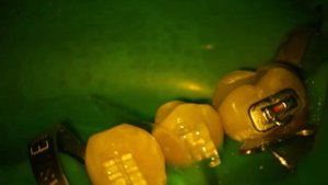 Лечение кариеса под микроскопом