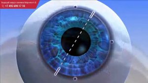 Имплантация мультифокальных ИОЛ
