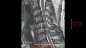 Грыжа 12 мм. шейного отдела позвоночника на уровне С6-С7. Отзыв пациента