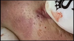 Acne Pimple Popping Blackhead removal - Blemish Extraction Treatment - Health & Beauty