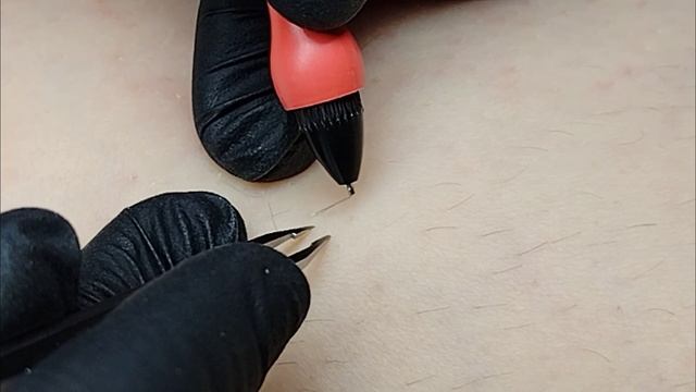 Электроэпиляция в Сочи на Мамайке