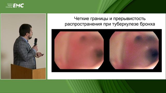 4Роль ISCAN в диагностике специфических поражений трахеобронхиального дерева Маменко ИС Васильев ИВ