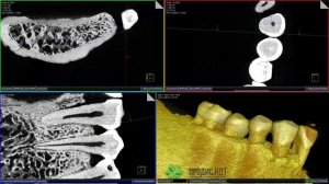 Видео КЛКТ реконструкции челюсти