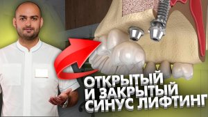 Открытый и закрытый синус-лифтинг в стоматологии, что это такое?