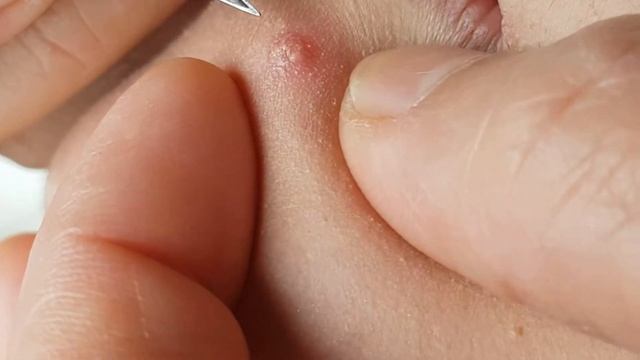 #6 pimples HD cravos 黑頭粉刺 मुहासा สิวหัวดำ الرؤوس السوداء على zits смотреть онлайн