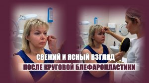 Круговая блефаропластика для свежести взгляда