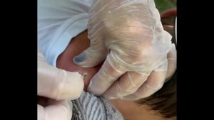 Big Pimple Popping Videos