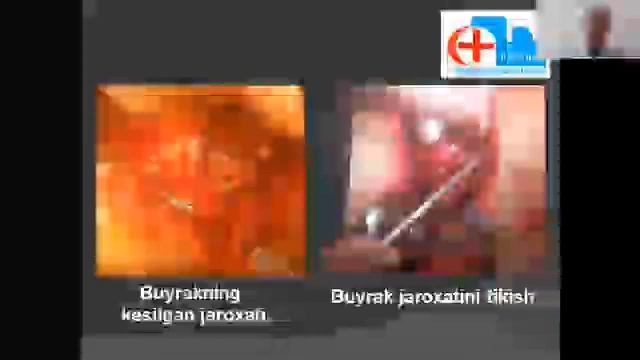 Siydik ajratish a'zolari shikaslanishlari