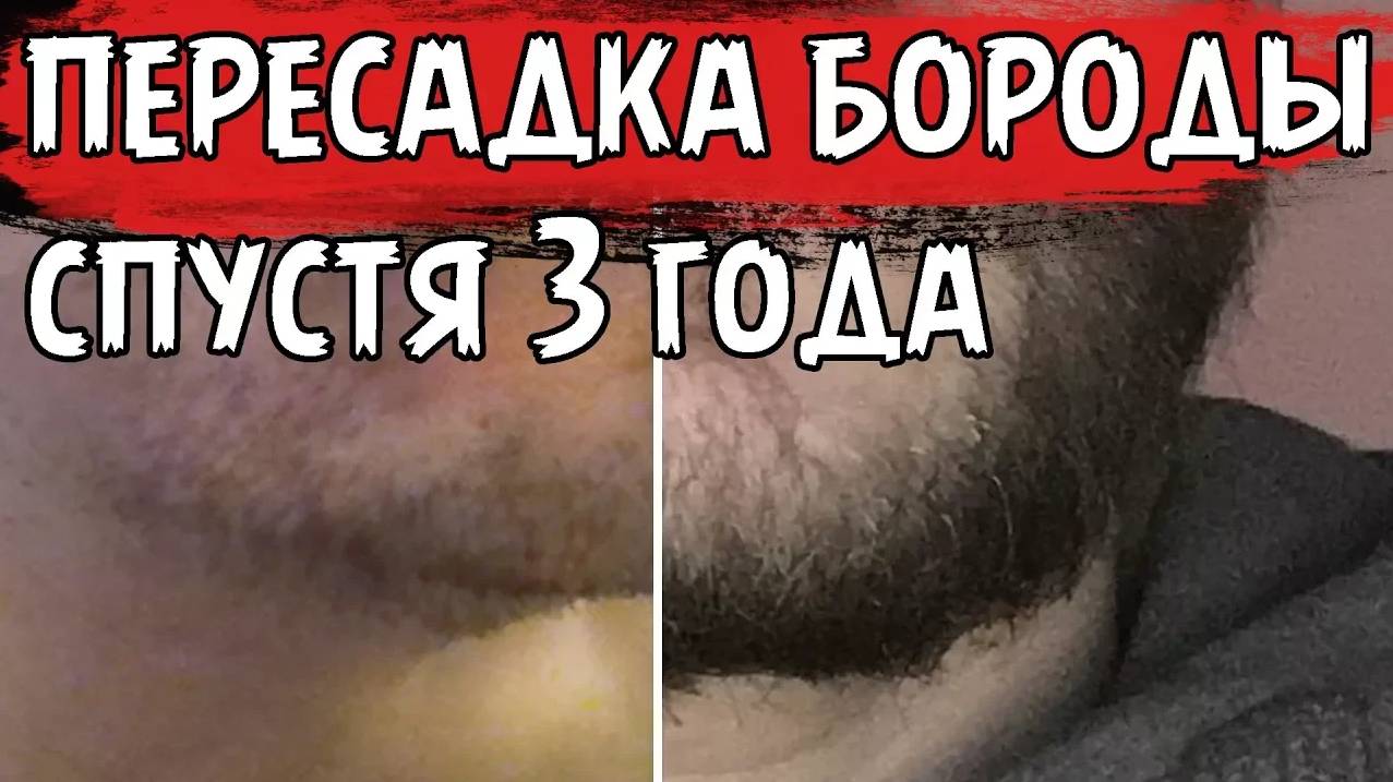3 ГОДА ПОСЛЕ ПЕРЕСАДКИ БОРОДЫ!