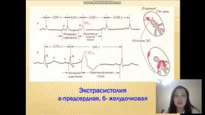 Аритмия 1