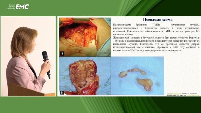 4. LAMN-загадка для эндоскописта, редкость для патоморфолога Дроздова Н.Н., Жаров А.А, Гурьянова Ю.В