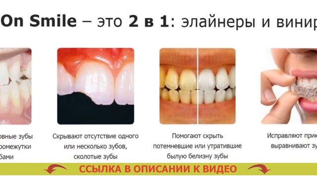Съемные Виниры Купить В Аптеке Спб