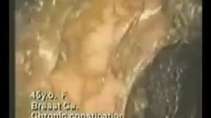 Разные стадии загрязнения кишечника и сопутствующие заболевания. Чистый кишечник - залог здоровья!